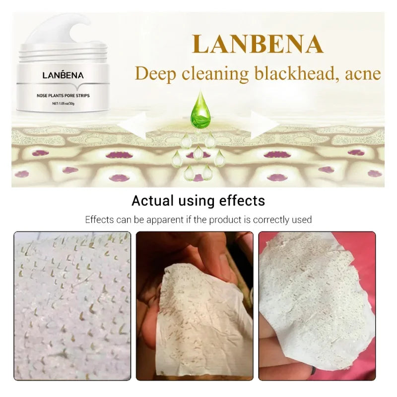 LANBENA, blackhead remover